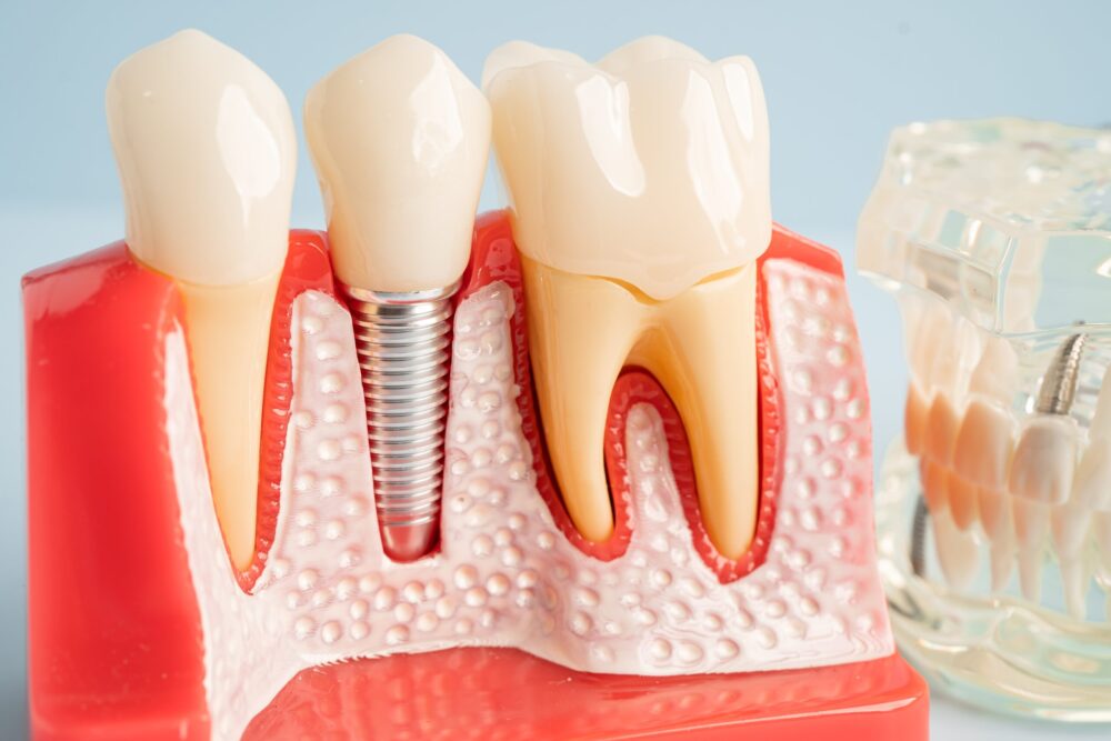Dental Implants Boynton Beach