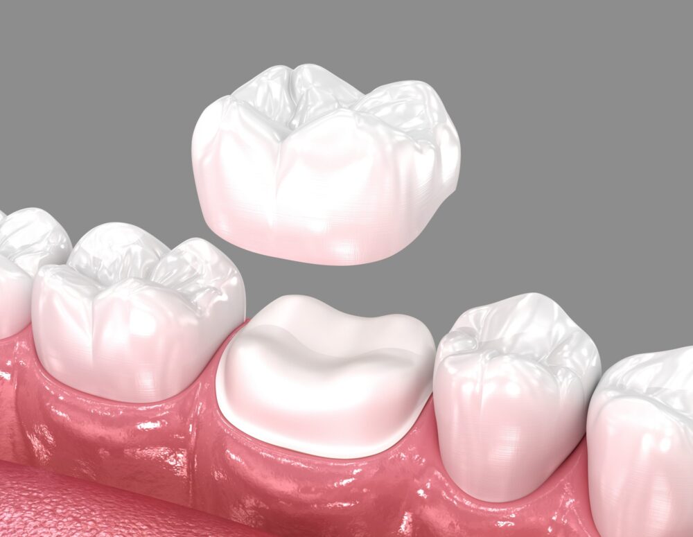 Dental Crowns Boynton Beach