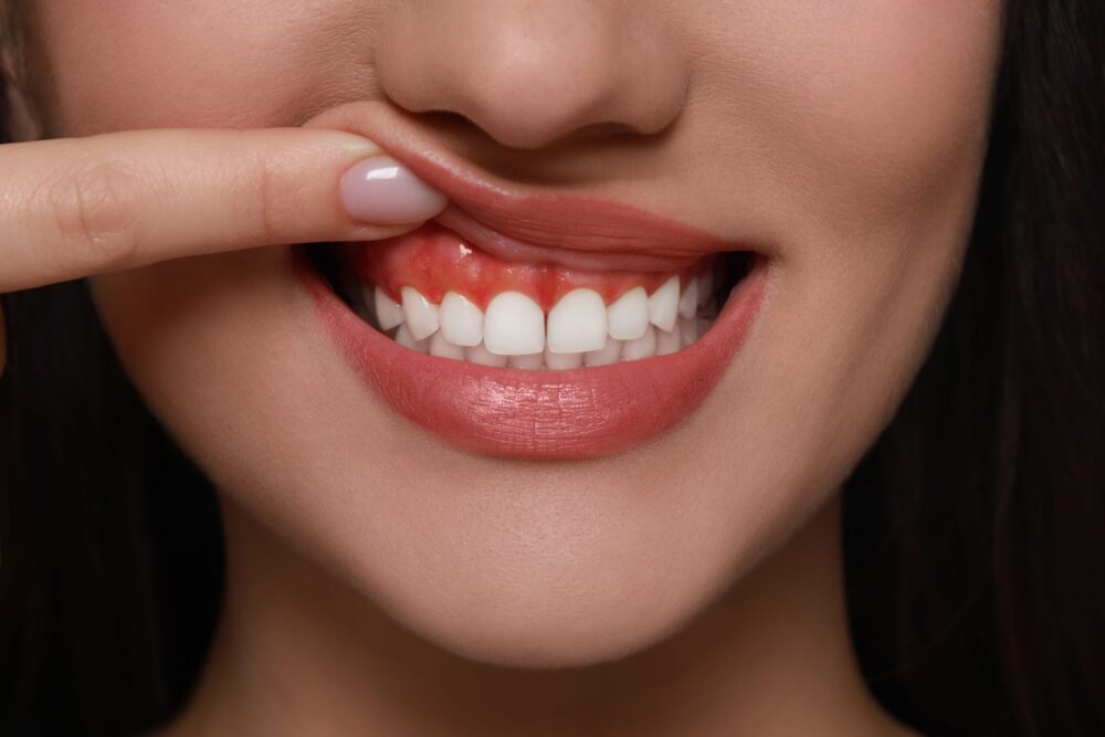 Gum Disease Treatment Boynton Beach